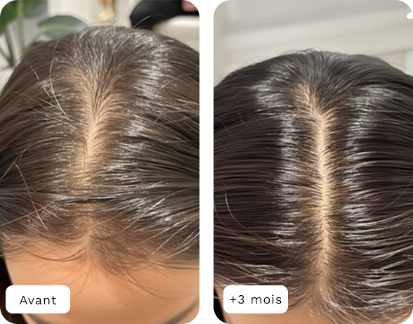 Gummies à la biotine pour des cheveux plus forts, plus denses, dès le premier mois.